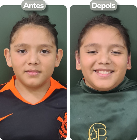 Otomodelação em crianças